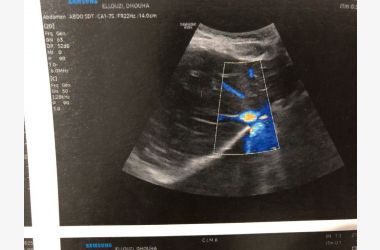 مساعدة للعلاج